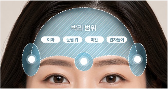 처진 조직을 정확하게 리프팅