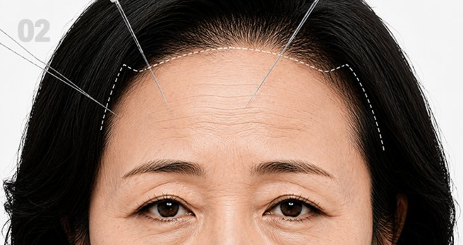 내시경을 통한 정밀한 박리